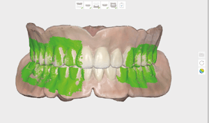 Denture-Scanning