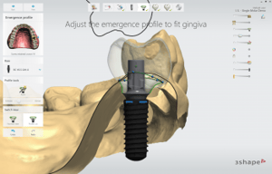 3Shape-Implant-Studio-2019_Screw-retained-crown-emergence-profile-350x224-1