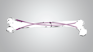 MJ Flex Nail in Bone