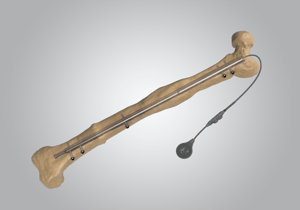 Fitbone-Transport-and-Lengthening-system