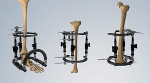 TLEVO-Primary-960x538_Fracture-management-2-768x430