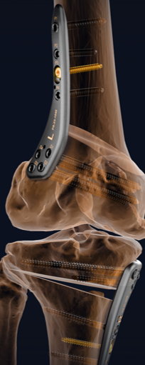 smart osteotomy-title